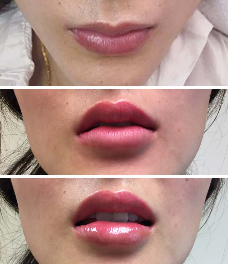 Dermal-filler-lip-02 Dermal Filler result progress on female patient