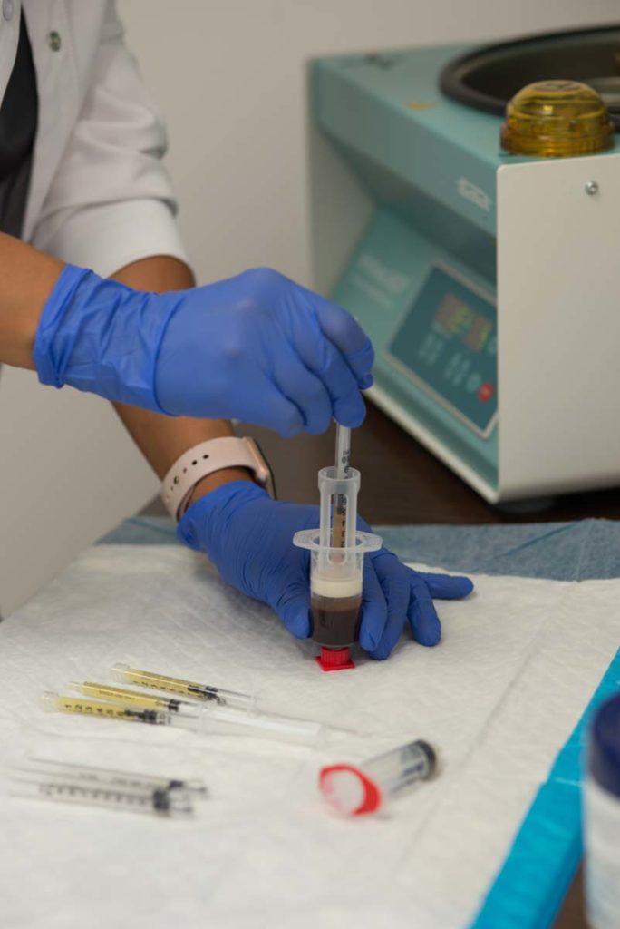 Female technician preparing blood for prp platelet rich plasma vampire facelift