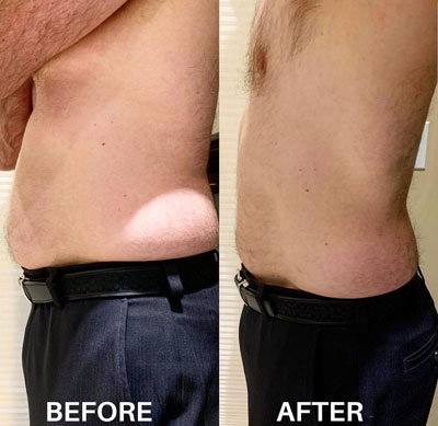 image00005 A man's body before and after a SculpSure treatment.