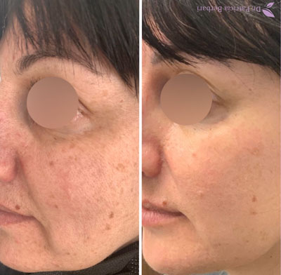 image00011 A woman's face before and after Fractora treatment.