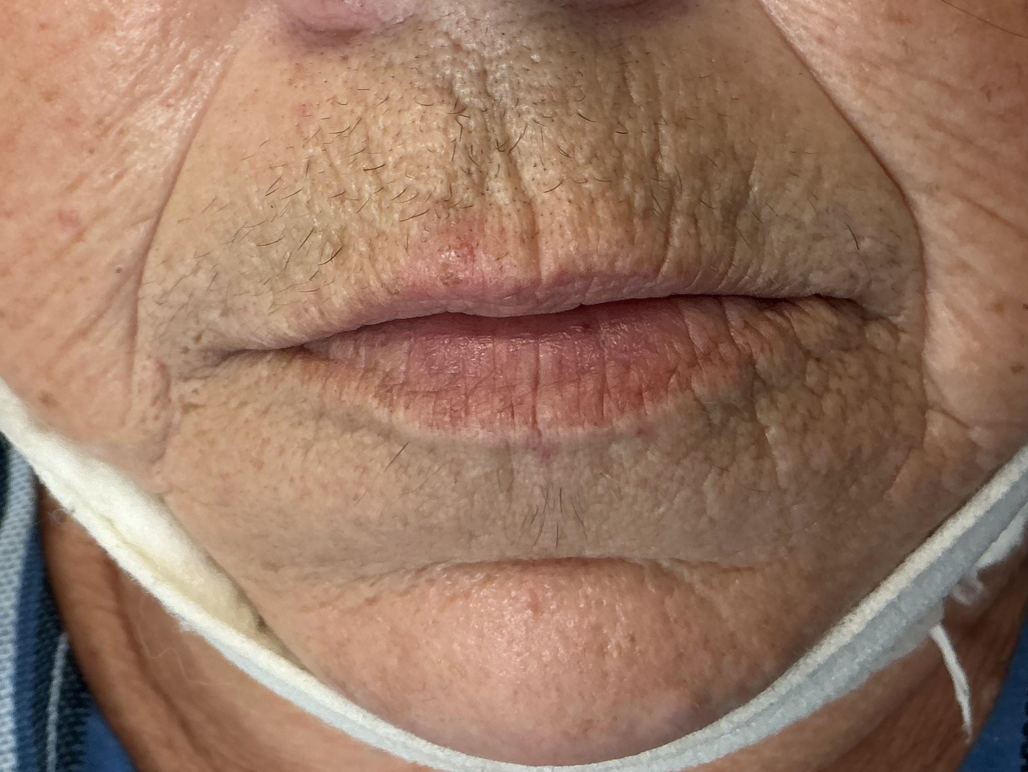SKINVIVE™ by JUVÉDERM® 1 Before * Ces photos sont publiées à titre indicatif afin de fournir l’information sur la nature de l’intervention. Elles ne constituent aucunement une garantie de résultat.