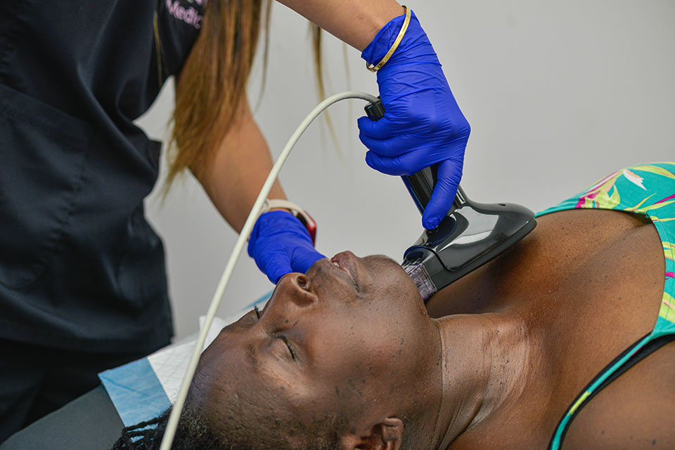 Morpheus8 Neck wrinkle treatment with microneedling and radio frequency