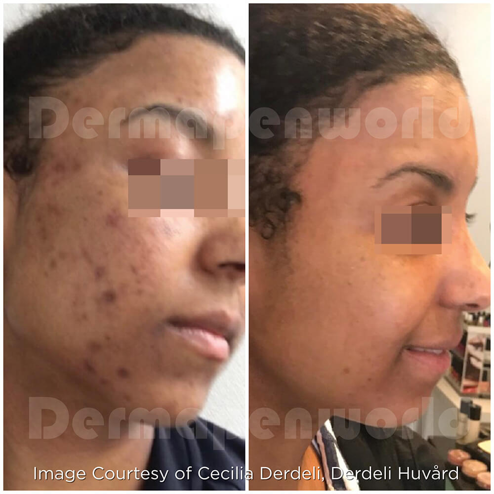 Microneedling results 4